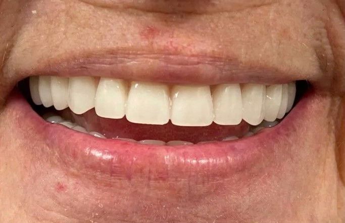 A close up of a person 's smile with white teeth.