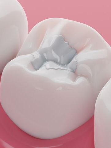 A close up of a tooth with a filling in it on a pink surface.