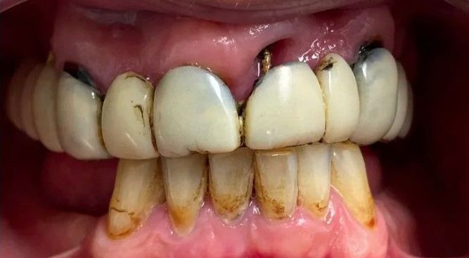 A close up of a person 's teeth with a broken tooth.