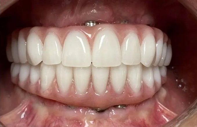 A close up of a person 's mouth with white teeth.