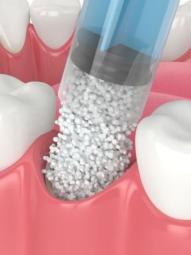 A 3d rendering of a dental implant being inserted into a tooth.