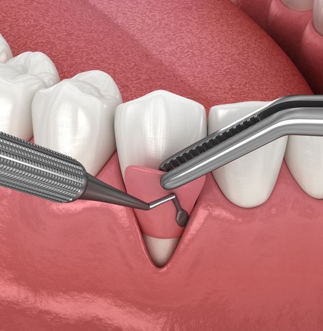 A close up of a tooth being examined by a dentist.