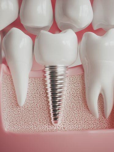 A close up of a tooth with a dental implant in it.