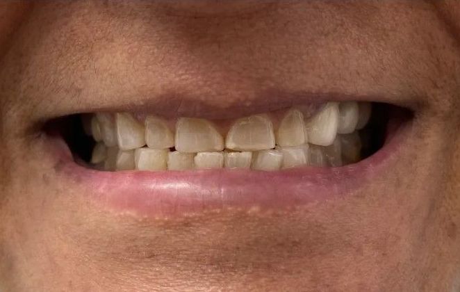 A close up of a person 's mouth with their teeth showing.