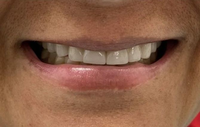 A close up of a person 's smile with white teeth.