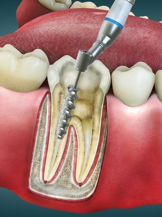 A dental drill is being used to remove a tooth.