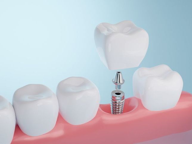 An illustration of a dental implant being placed in a tooth.