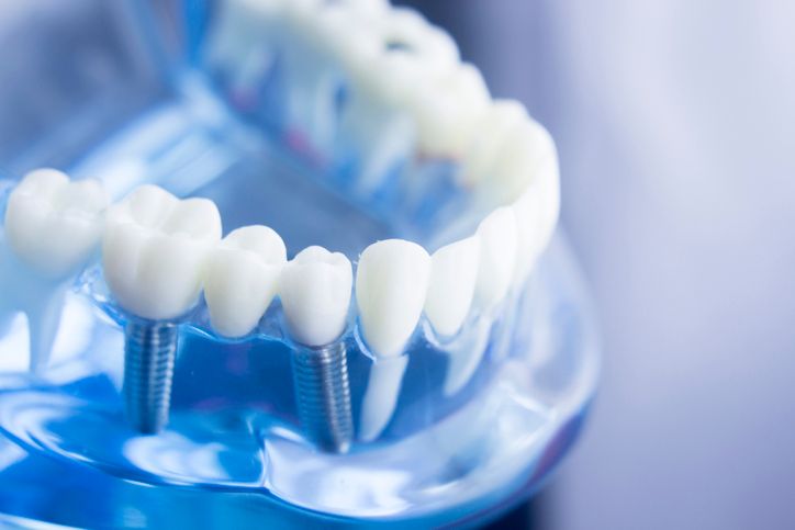 complete dental works dental implants