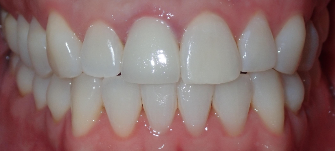After Zoom Whitening
