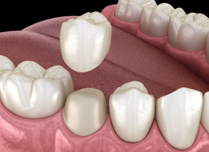 A computer generated image of a dental crown being placed on a tooth.