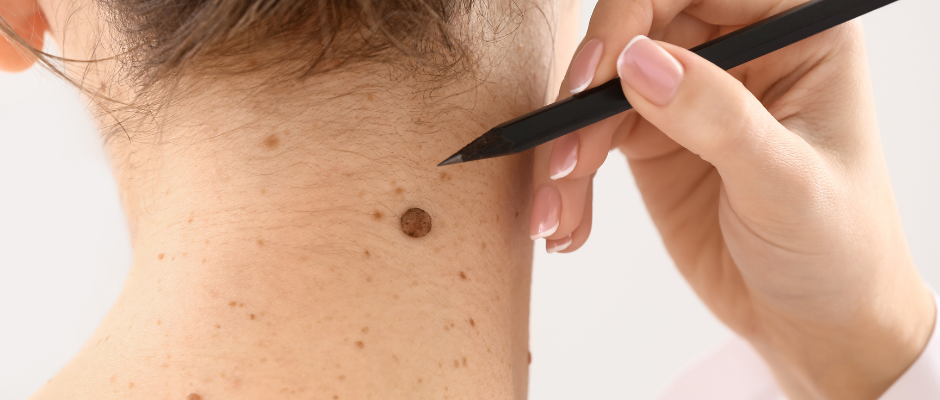 Mole Removal | PrimeMed Mole Removal | PrimeMed