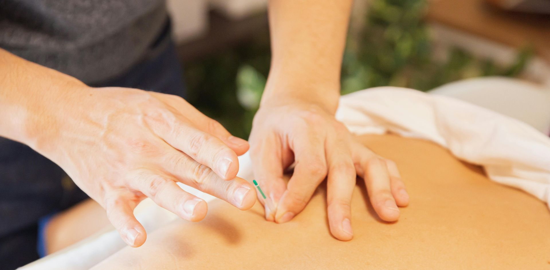 Dry needling in Mackay