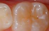 tooth before sealant applied