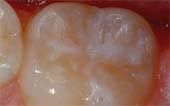 tooth after sealant applied