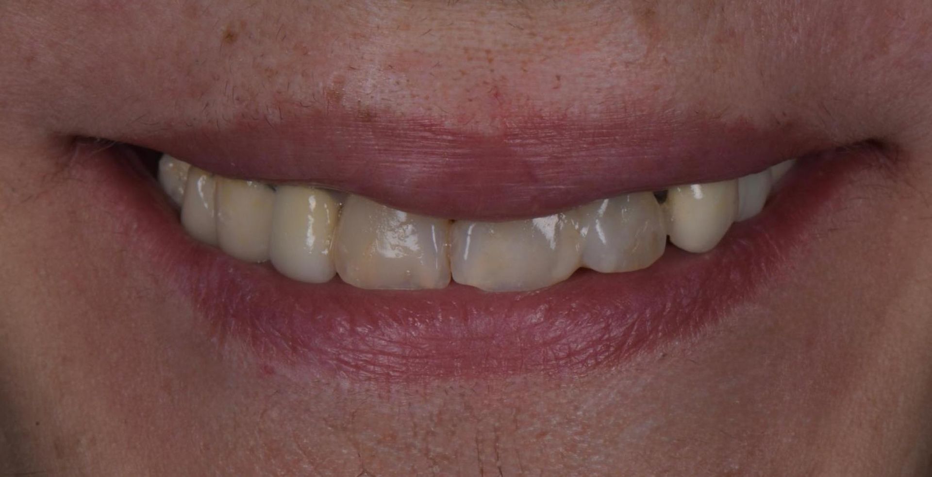 Primo piano di una bocca sorridente con denti incisivi leggermente irregolari e labbra rosa.