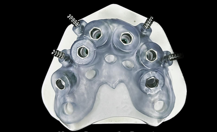 Bocca aperta che mostra l'apparecchio dentale superiore con ganci metallici e fori di fissaggio verdi.