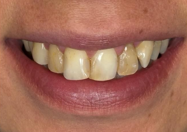 Primo piano di una bocca sorridente con denti incisivi leggermente irregolari e labbra rosa.