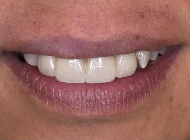 Primo piano di una bocca sorridente con denti bianchi e labbra rosa