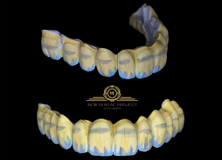 Protesi dentaria con denti bianchi e gengive rosa, tenuta in una mano guantata su sfondo nero.