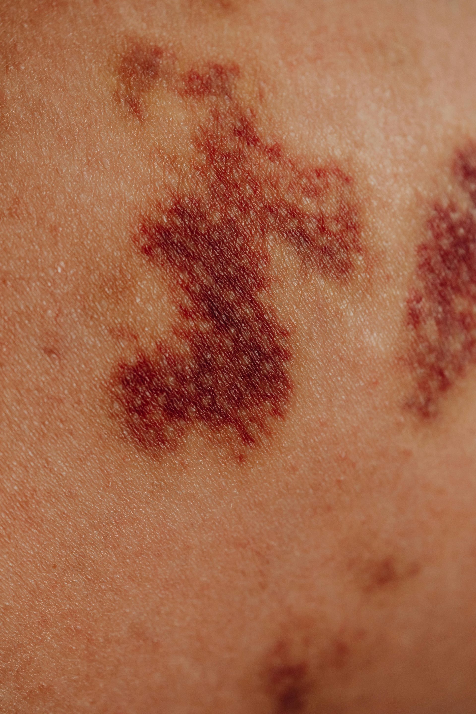 Plaque Psoriasis