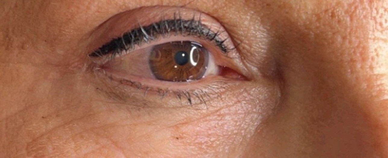 A close up of an older woman 's brown eye with a blue pupil.