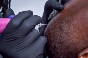 Scalp Pigmentation