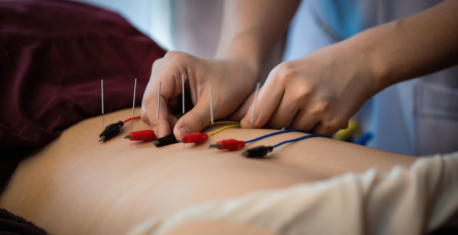 A person is getting electro acupuncture on their back