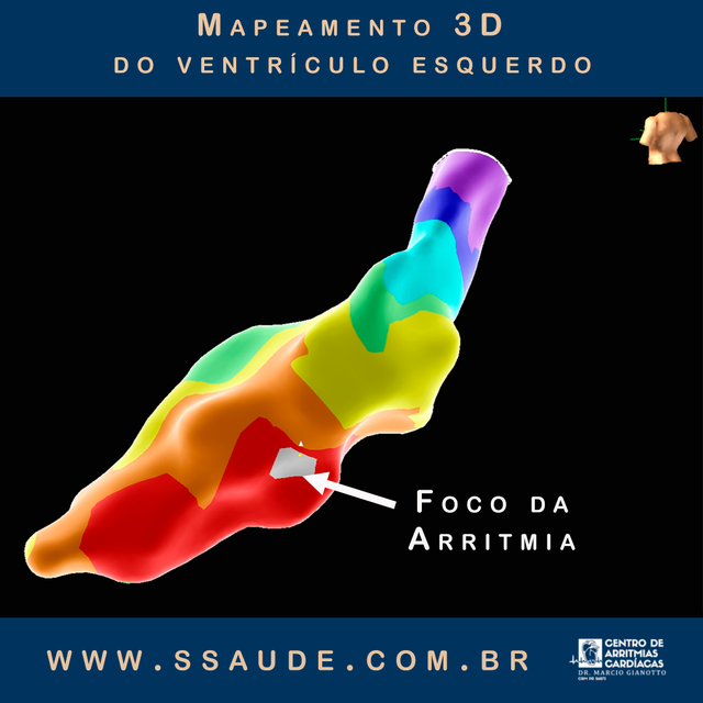 Tilt-test para avaliação de desmaio e síncope em Maringá