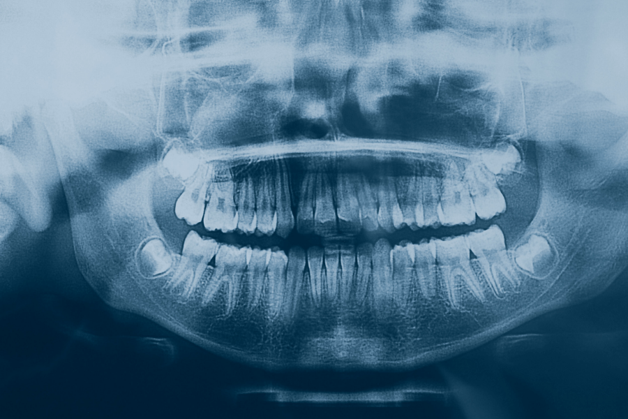 A panoramic dental x-ray — The Center for Sleep Apnea and TMJ — Boise, ID