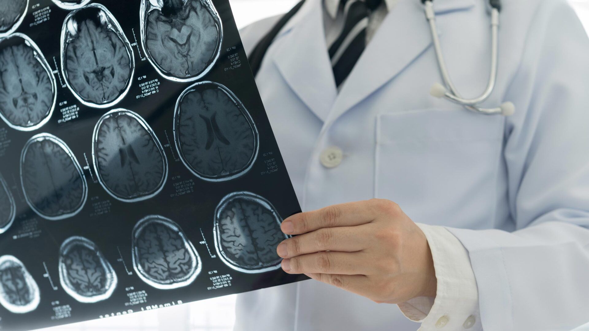 Brain MRI — Roseville, CA — Frank Penney Injury Lawyers