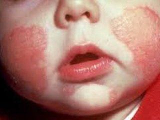 Reazione allergica neonato