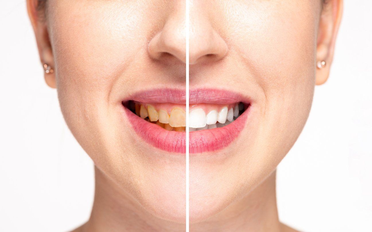 before and after smile makeover