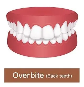 Example of Overbite Problem