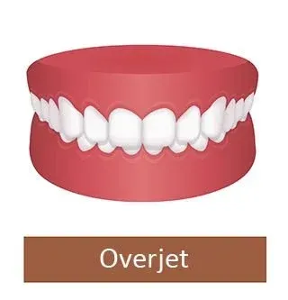 Example of Overjet Problem
