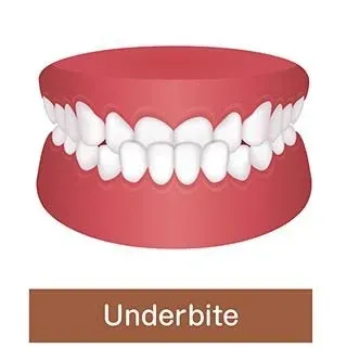 Example of Underbite Problem
