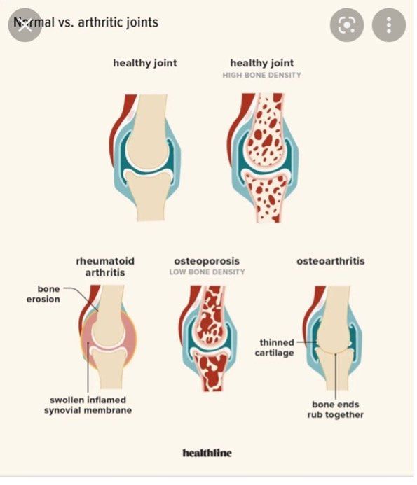 what-does-arthritis-mean-to-you