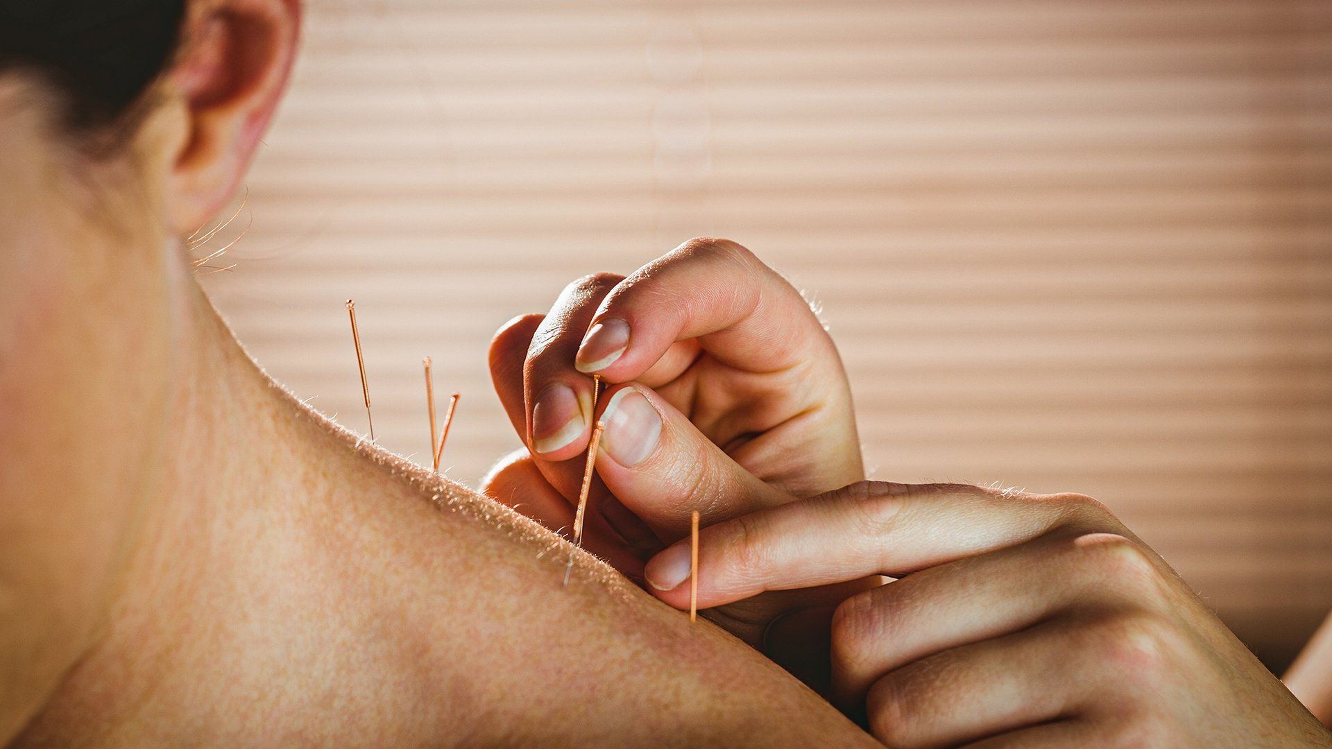 acupuncture