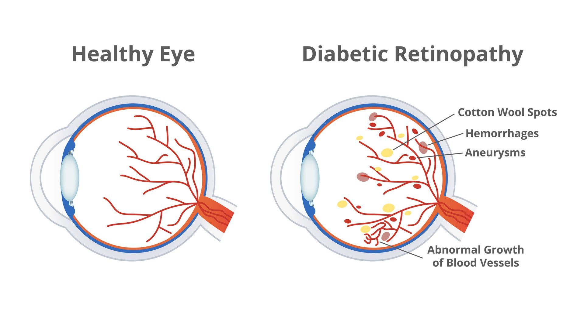 Healthy Eye vs Eye with Diabetic Retinopathy