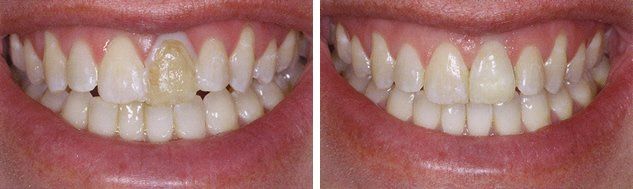 Porcelain Crowns - Dental Services in Clay, WV