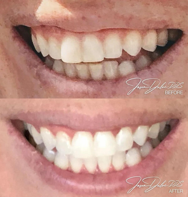 Teeth Whitening Before And After Crest