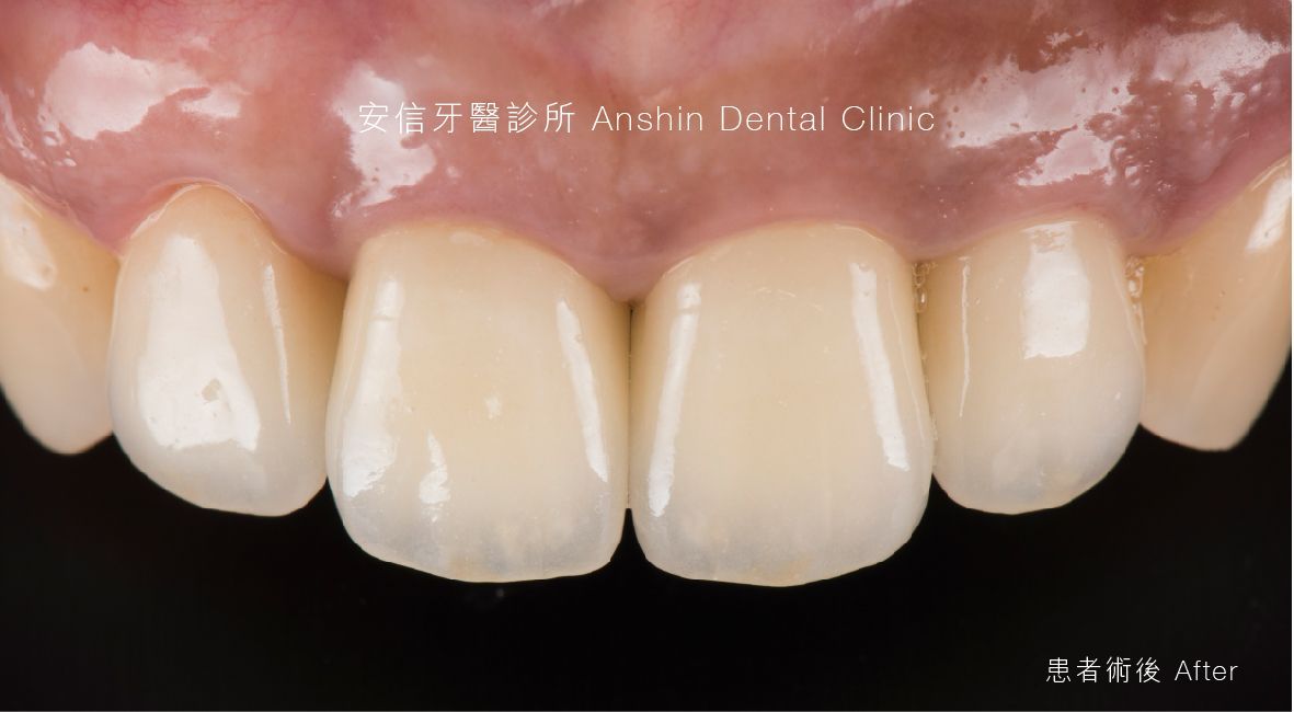 A close up of a person 's teeth with a black background.