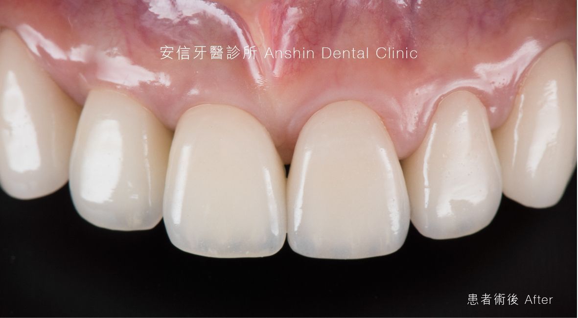 A close up of a person 's teeth with a black background.