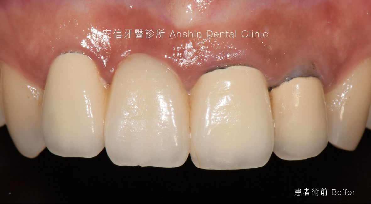 A close up of a person 's teeth with a broken tooth