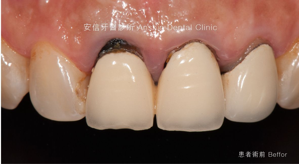 A close up of a person 's teeth with a missing tooth.