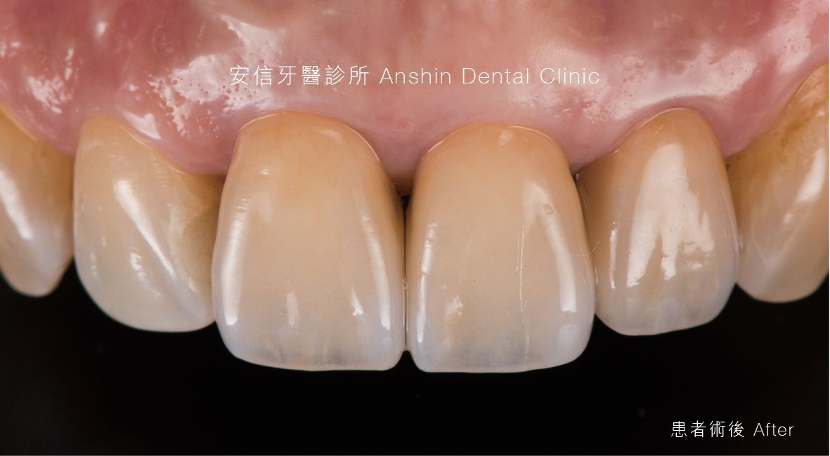 A close up of a person 's teeth with a black background.