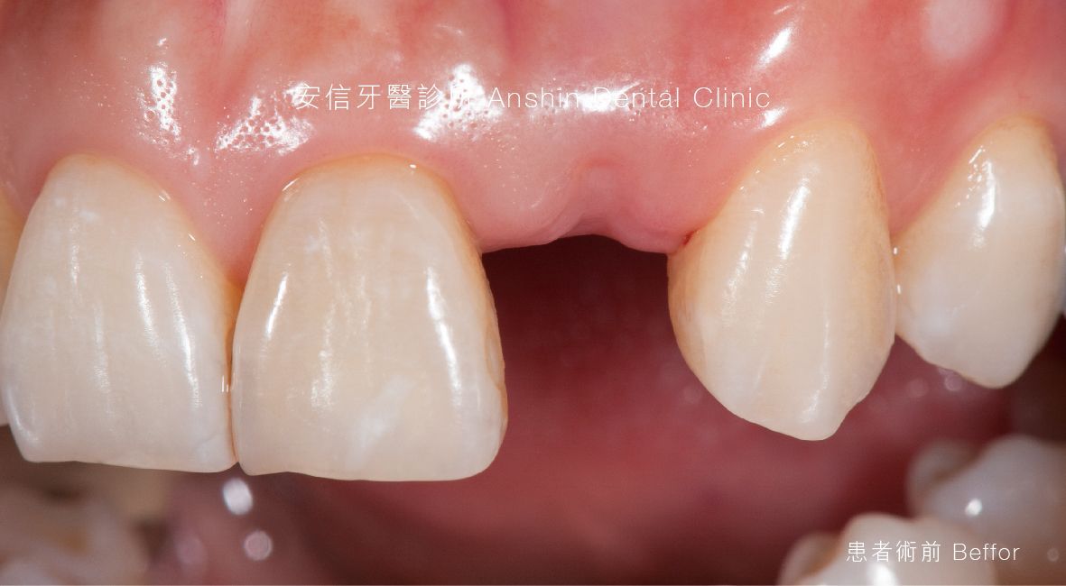 A close up of a person 's teeth with a missing tooth.