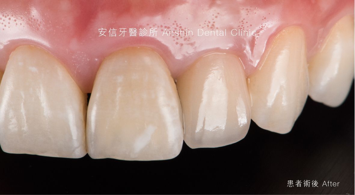 A close up of a person 's teeth with a black background.