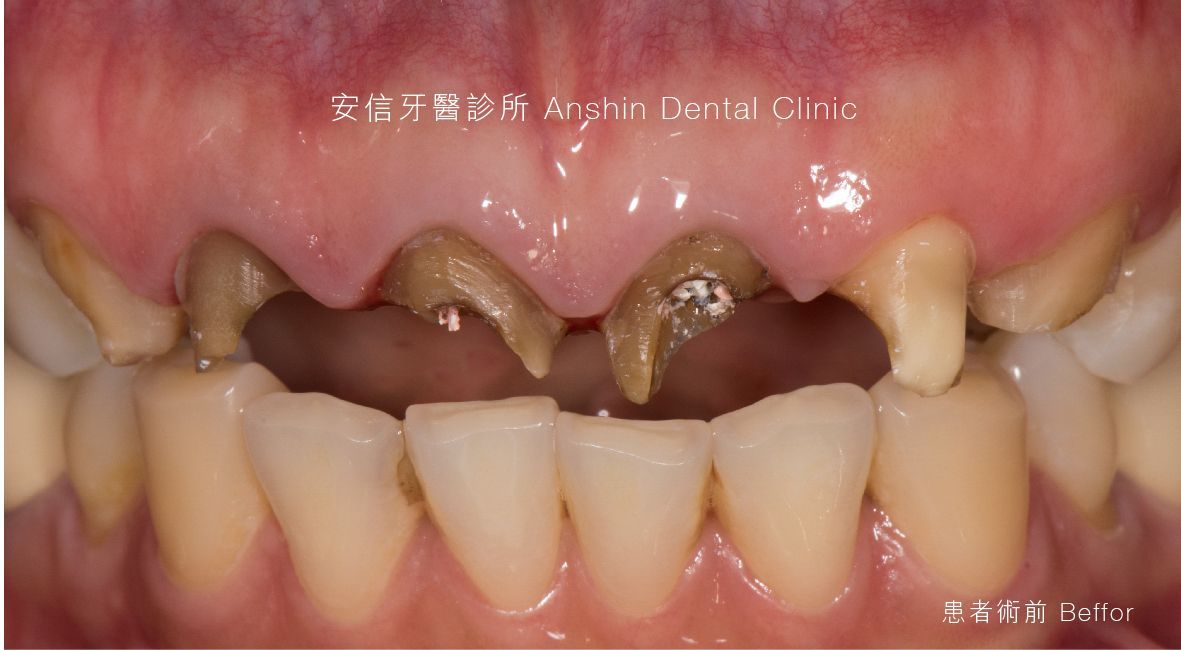 A close up of a person 's mouth with a lot of teeth missing.