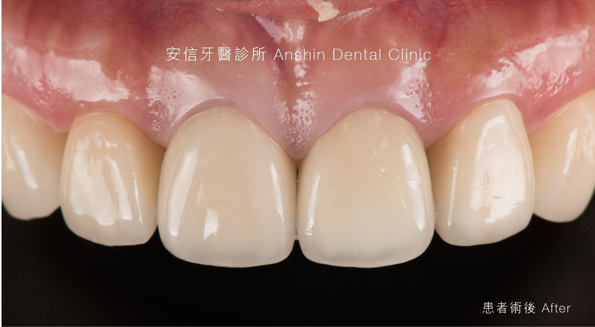 A close up of a person 's teeth with a black background.