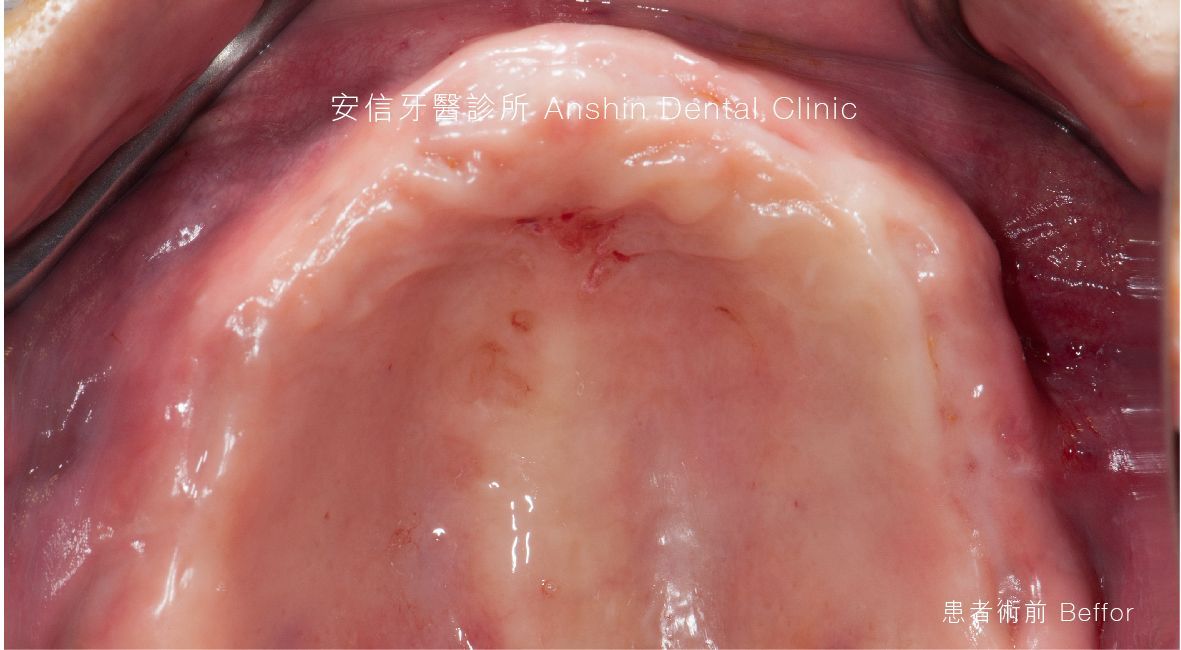 A close up of a person 's mouth with a tooth missing